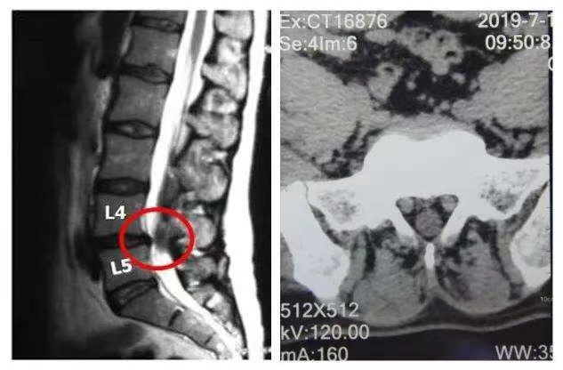闪腰了怎么办啊,经常闪腰怎么预防闪腰