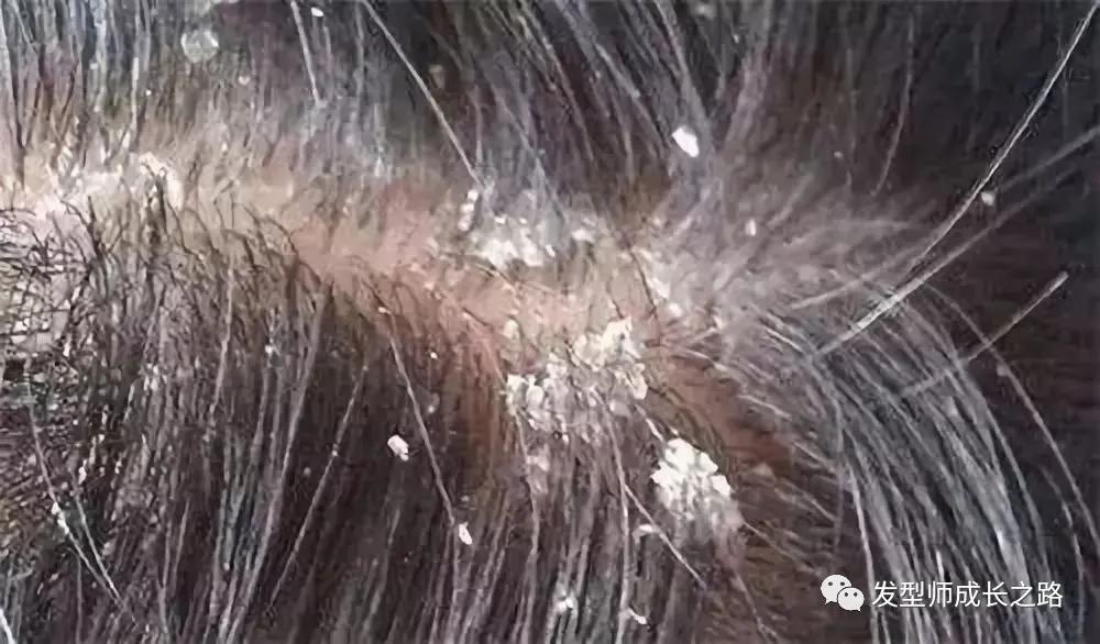 你真正了解ros吗,怎么真正治疗头皮屑