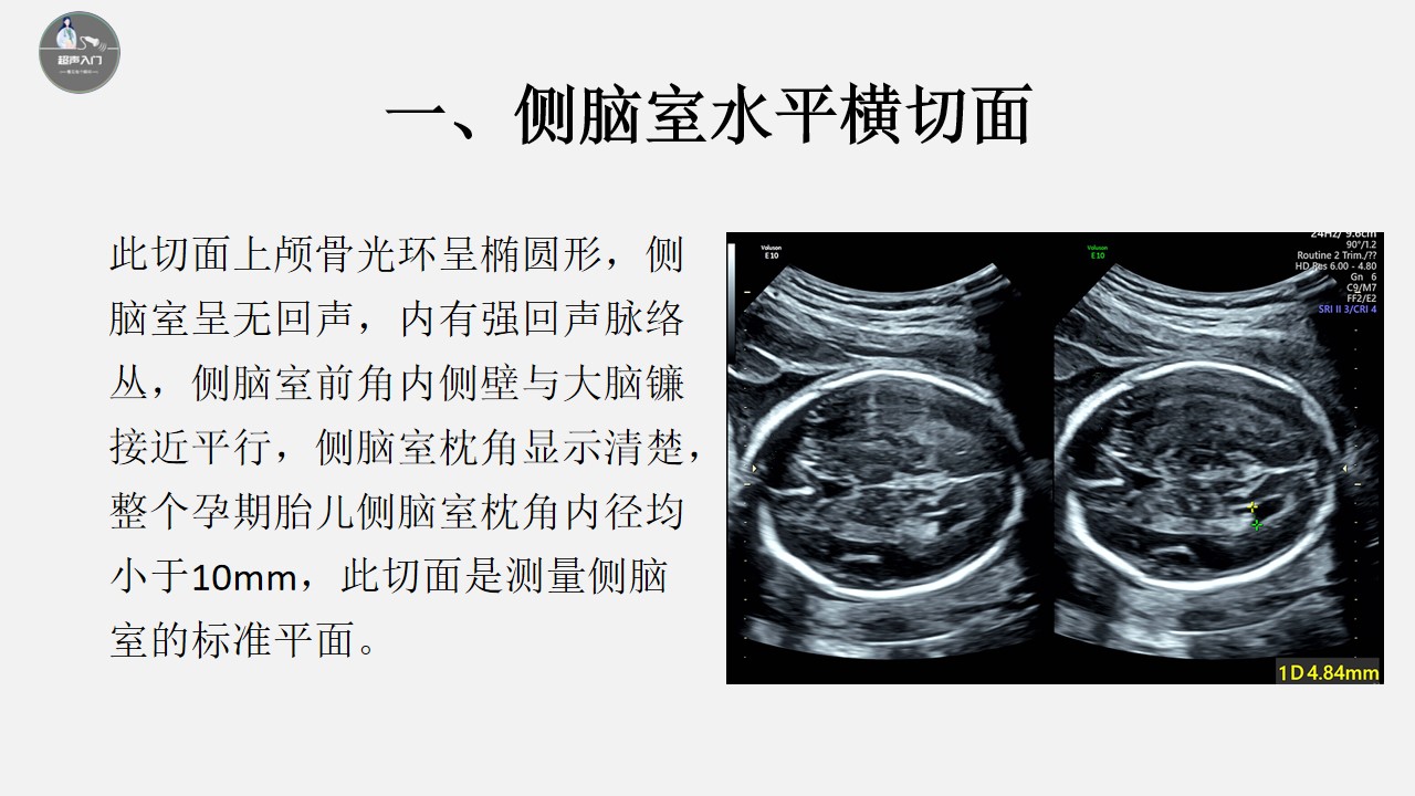 胎儿颅脑超声标准切面图解,胎儿颅脑异常的超声诊断ppt