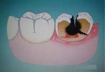 补过牙然后补的地方掉了,补过牙的地方又有蛀牙了