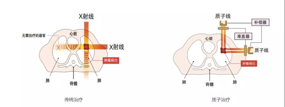 质子重离子应用得多吗,质子重离子是什么疾病