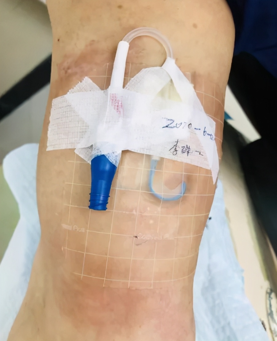 picc置管敷贴皮肤痒如何处理,picc置管防过敏贴膜进口