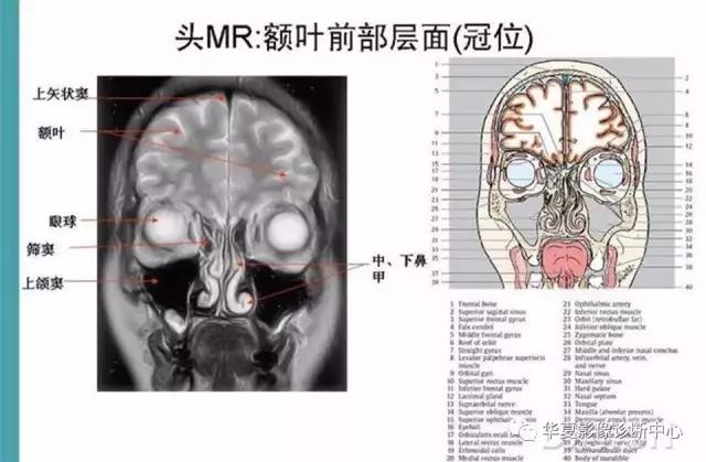 电子版头颅ct与mri断层解剖,头颅mri血管解剖与分段详解