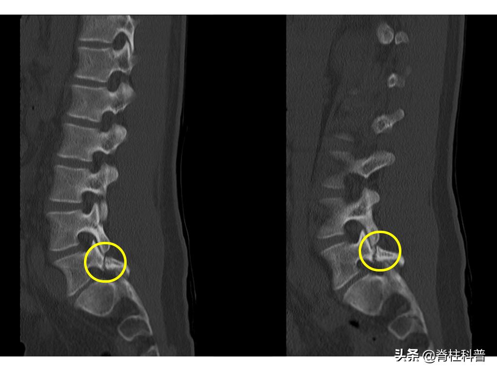峡部裂导致的滑脱是不是必须手术,峡部裂保守治疗的方式有哪些