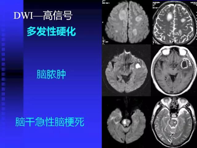 头颅mri读片视频教程,颅脑mri读片入门教程视频讲解全集