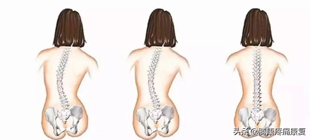 背阔肌综合征病历,背阔综合症