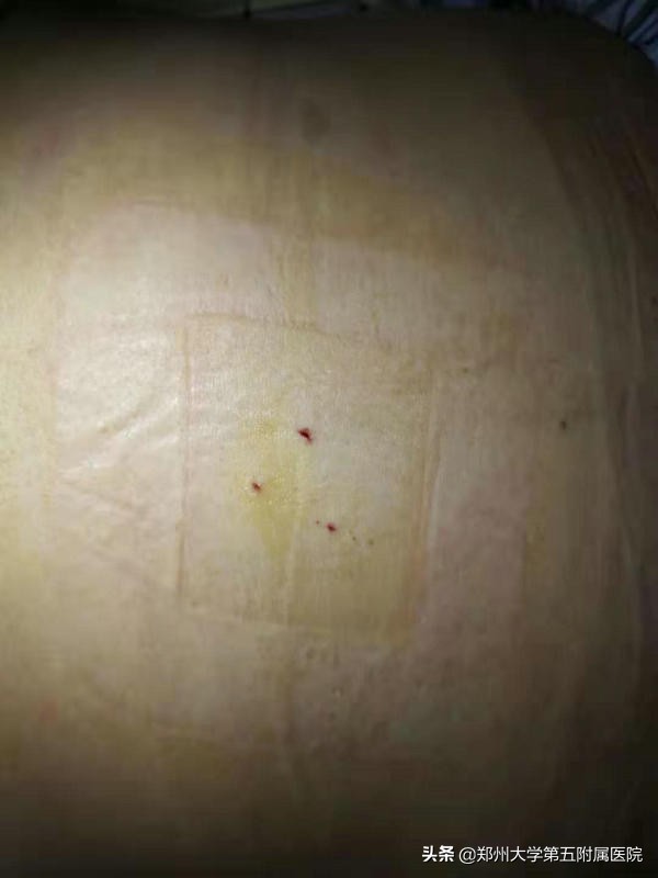 河南省肿瘤医院射波刀治疗胰腺癌,郑大第一附属医院治疗胰腺癌