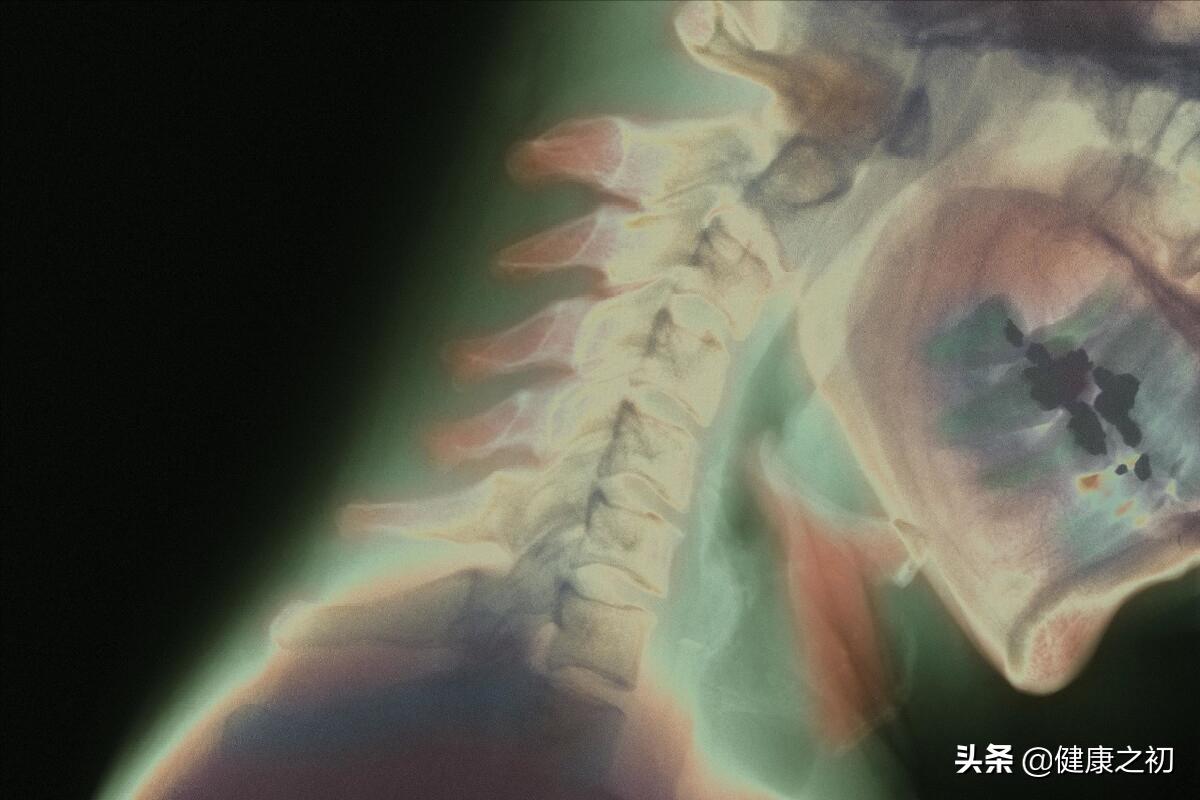 一直仰头会损伤脊髓吗,小孩脊髓损伤截瘫站起来了