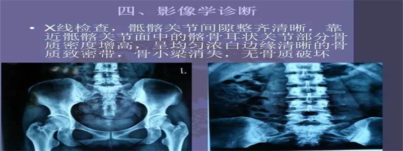 骶髂骨半脱位正骨手法大全,腰骶髂关节卡压很紧怎么整脊