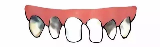 小孩得了奶瓶龋该怎么治疗,宝宝牙齿奶瓶龋怎样治