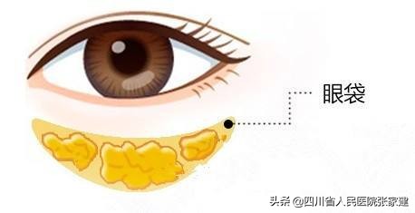 去眼袋手术各种后遗症怎么处理,祛眼袋手术有后遗症吗危险吗
