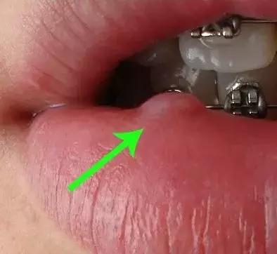 医保城健康网｜不可小看的口腔溃疡！