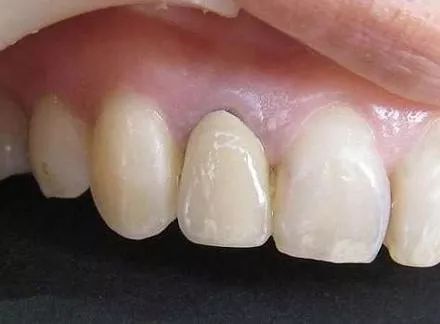 烤瓷牙做什么样的性价比高,沈阳烤瓷牙哪家便宜又好