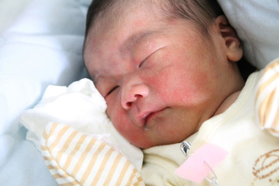 痱子和热疹有什么区别,痱子和热疹的区别