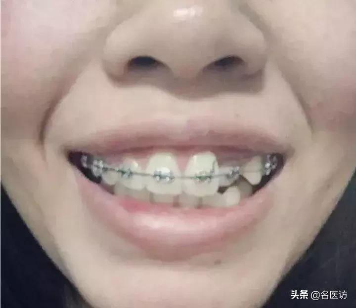 矫正牙齿后牙掉了,矫正牙齿只拔上面2颗牙