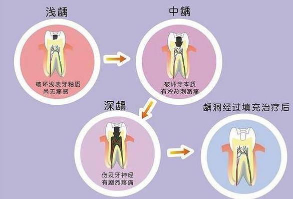 小小年纪就蛀牙是什么原因,小小的蛀牙
