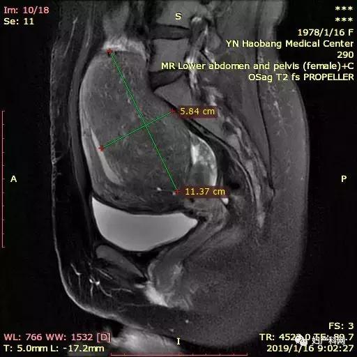 无症状子宫腺肌症可以不治疗吗,微无创超声介入