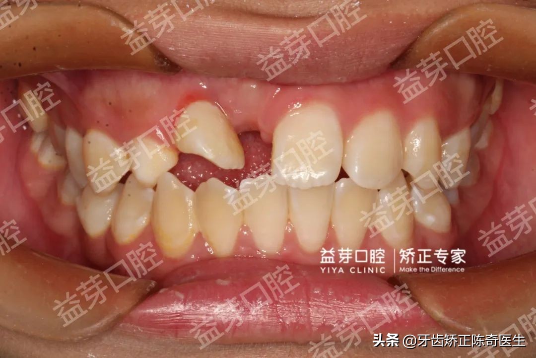 埋伏牙用隐形牙套怎么牵引,龅牙隐形牙套矫正全过程