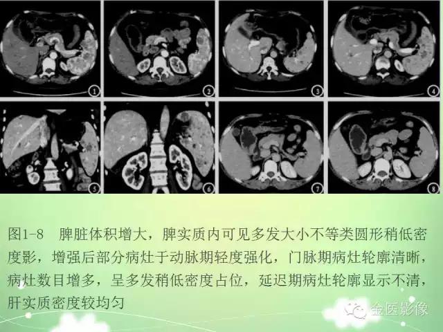 脾血管瘤中医辨证,脾血管瘤超声表现