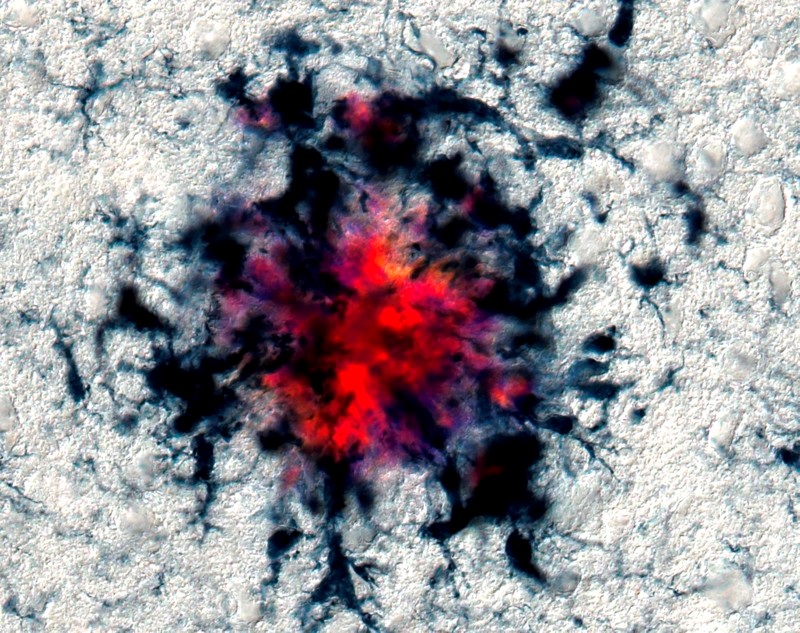 阿尔茨海默病与tau蛋白有关吗,淀粉样蛋白与阿尔茨海默病