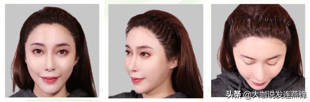 2500单位发际线,2000单位植发