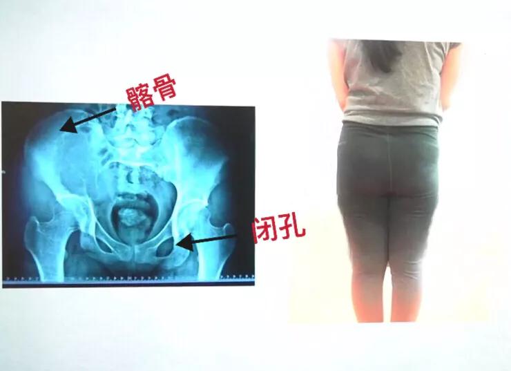 产后臀肥大怎么瘦,产后屁股变大怎么瘦下来