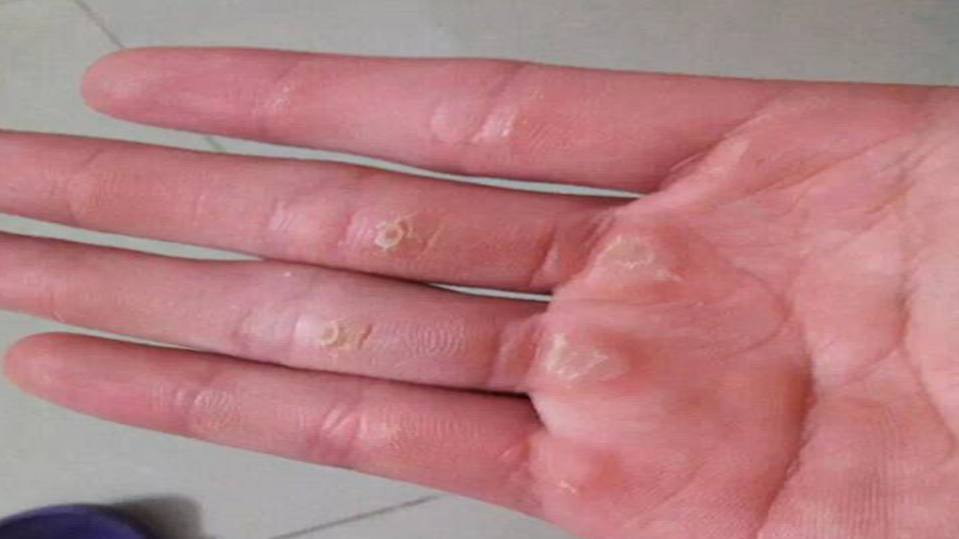 去手上老茧最简单方法,手上有老茧怎么消除