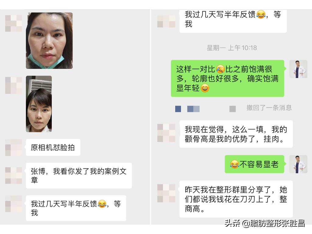 颧骨太高整形,颧骨高怎么整形有什么后遗症