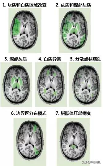 脑卒中的快速识别ppt,脑卒中神经影像学实例解析