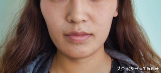 怎样可以去除法令纹和皱纹,如何消除法令纹提升脸部轮廓