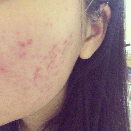 痘坑闭口痘印怎么祛除,怎么祛深层痘印和痘坑呢