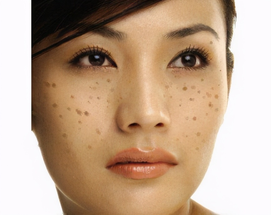 脸上的斑一直去不掉是怎么回事,脸上的色斑一直不消怎么办