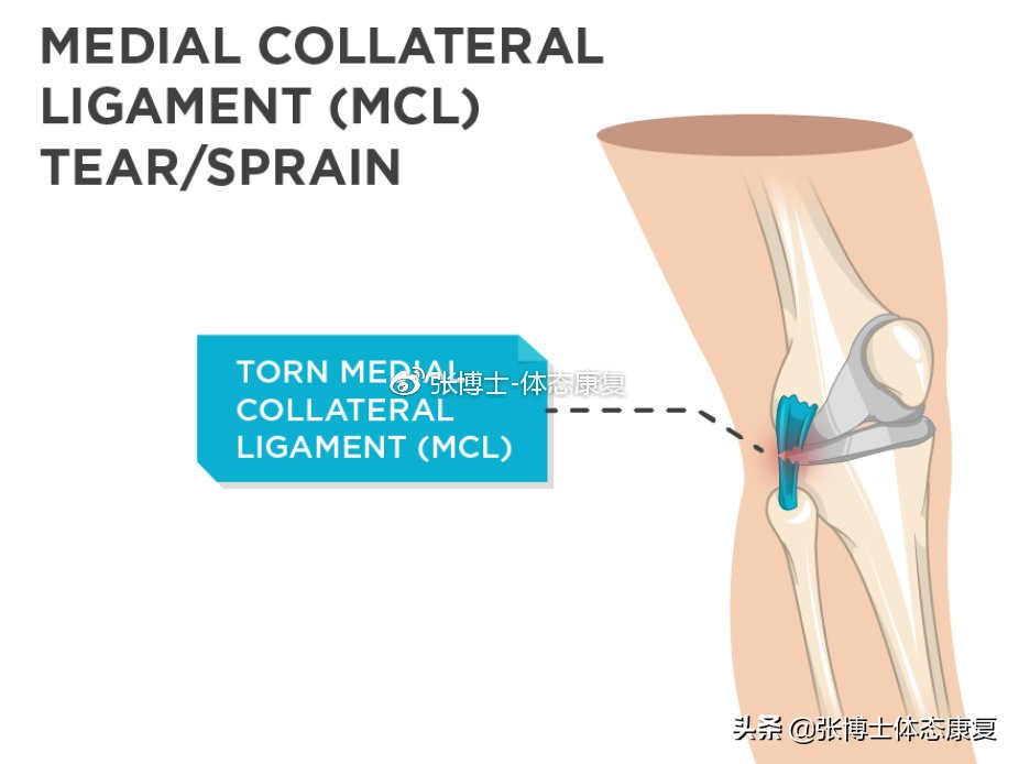 【运动康复科普】为什么你的膝关节内侧会出现疼痛？