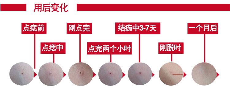 激光祛痣用什么药祛疤,激光点痣留疤几率多大