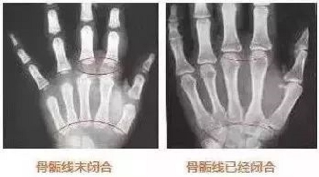 想让孩子长高听听专家怎么说,父母个子都矮孩子怎么才能长高