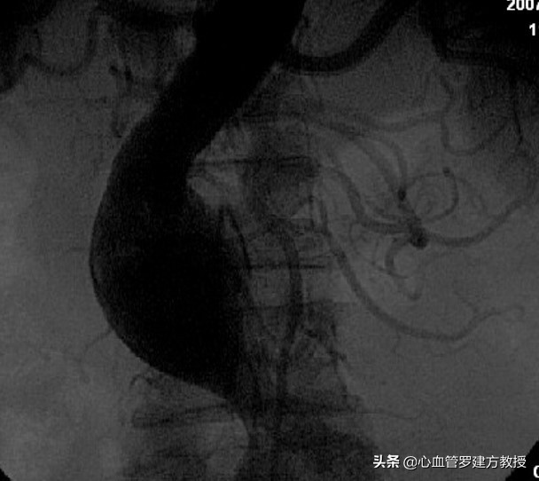 得了腹主动脉瘤该怎么治疗,腹主动脉血管狭窄怎么治疗