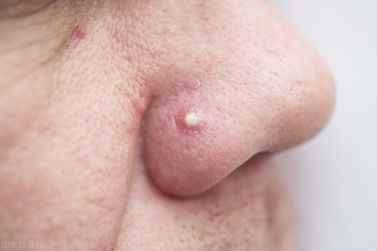 鼻子上挤出来的白色丝状物到底啥,鼻子上挤出来的白色丝是什么