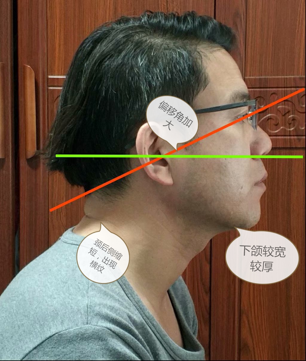 很瘦却有双下巴是什么原因,长得瘦却有双下巴