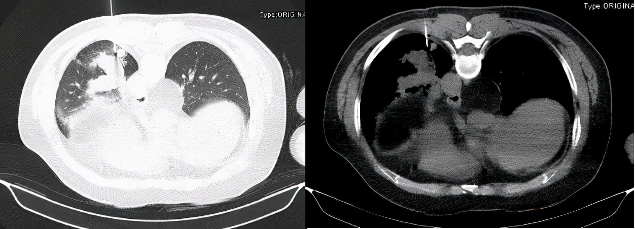 咳嗽10多天了有白痰细菌感染,咳嗽是肺部真菌感染吗