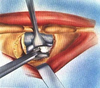 腰椎间盘突出该怎么选择手术方案,腰椎间盘突出症手术方式有哪些