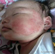 一般的湿疹膏,一擦就见效的护肤品打假