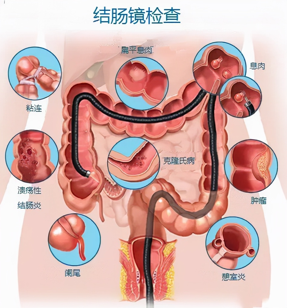 做普通胃镜肠镜的真实感受,做了胃肠镜还有必要做胃镜吗