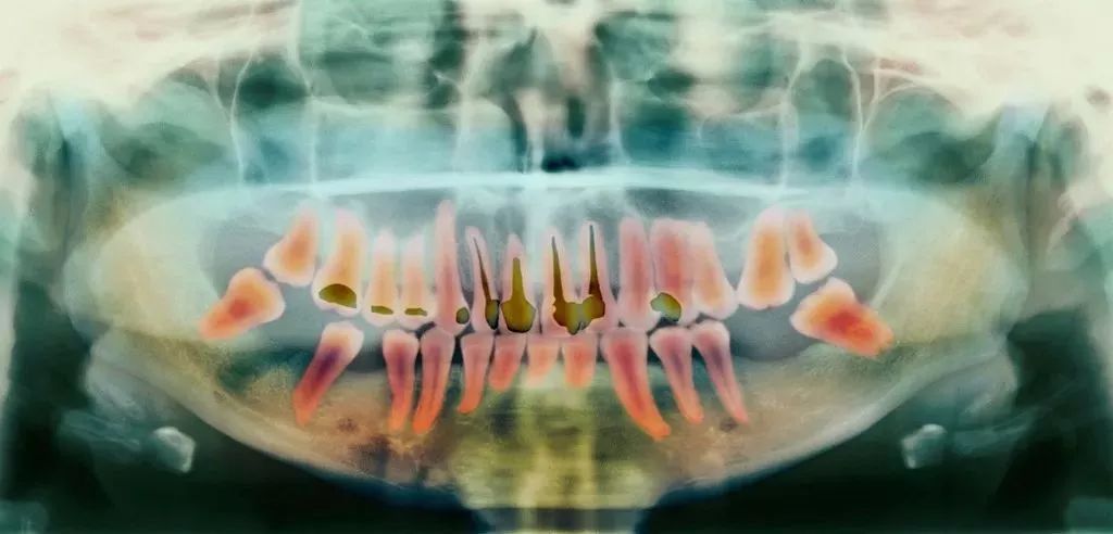 牙蛀了要补吗,牙齿蛀了一点需要补牙吗