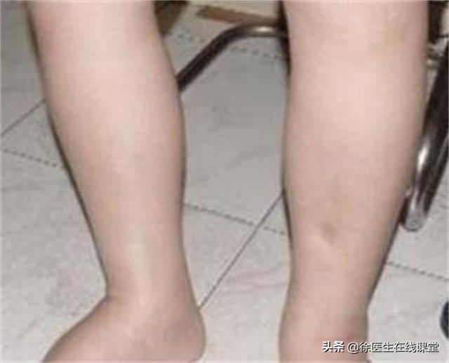 肾病综合征患者得肺癌怎么治疗,肾病综合征与肺癌患者