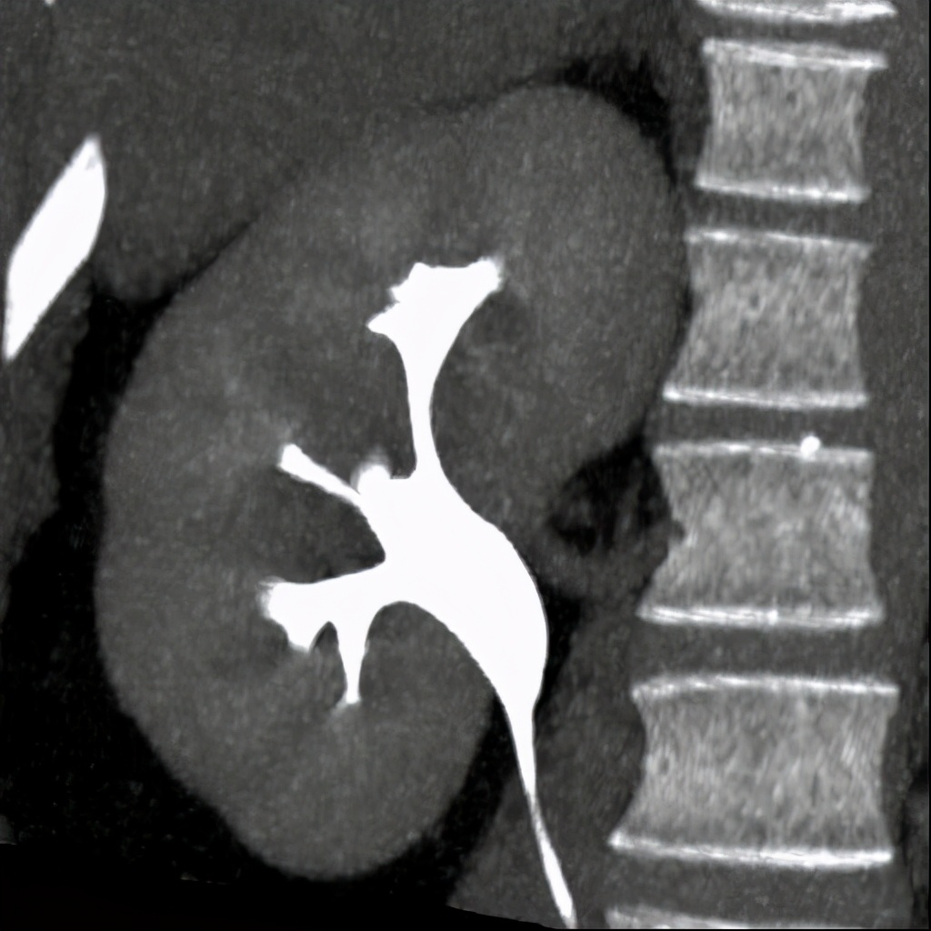 尿路造影输尿管间断显影,静脉尿路造影和排泄性尿路造影