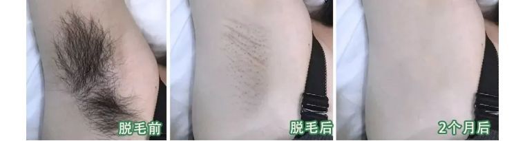 j-style脱毛仪测评,j-style美容仪好用吗