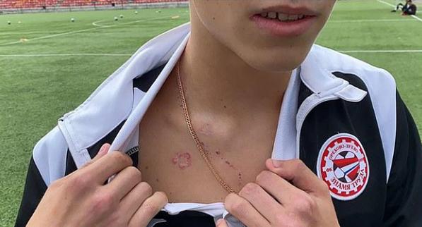 9岁男孩踢球时被闪电击中,男孩被闪电击中后续