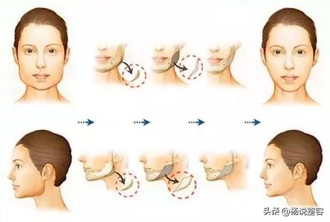 为什么会下颌突出,为什么下颌角突出