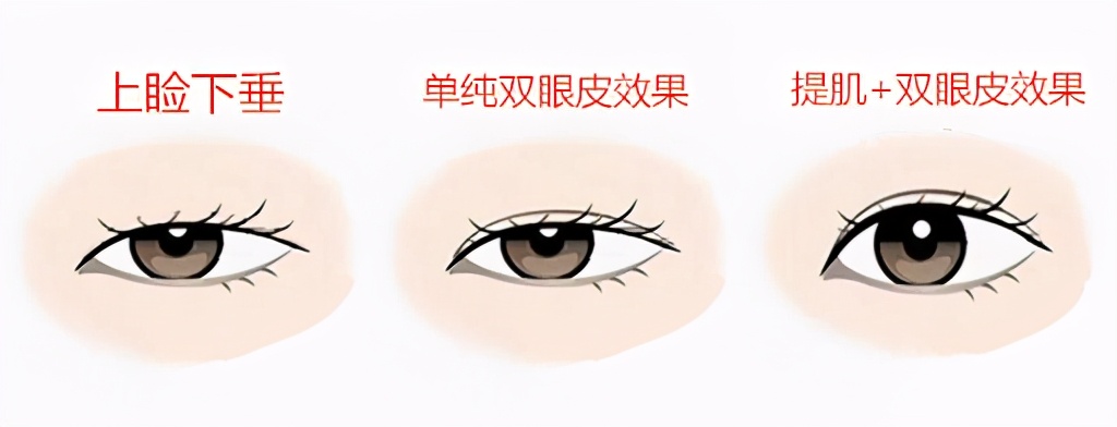 做双眼皮时判断出肌无力但未提肌,做双眼皮说是眼睛肌力不够