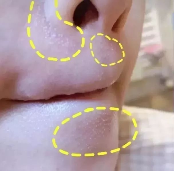 下巴挤出小米粒样的东西,下巴闭口挤出来的东西臭